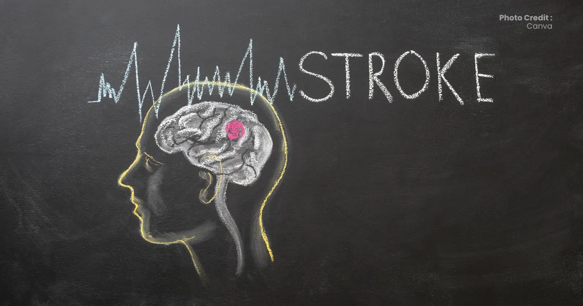 Cara Mencegah Stroke: Panduan Lengkap Berbasis Bukti untuk Warga Banda Aceh